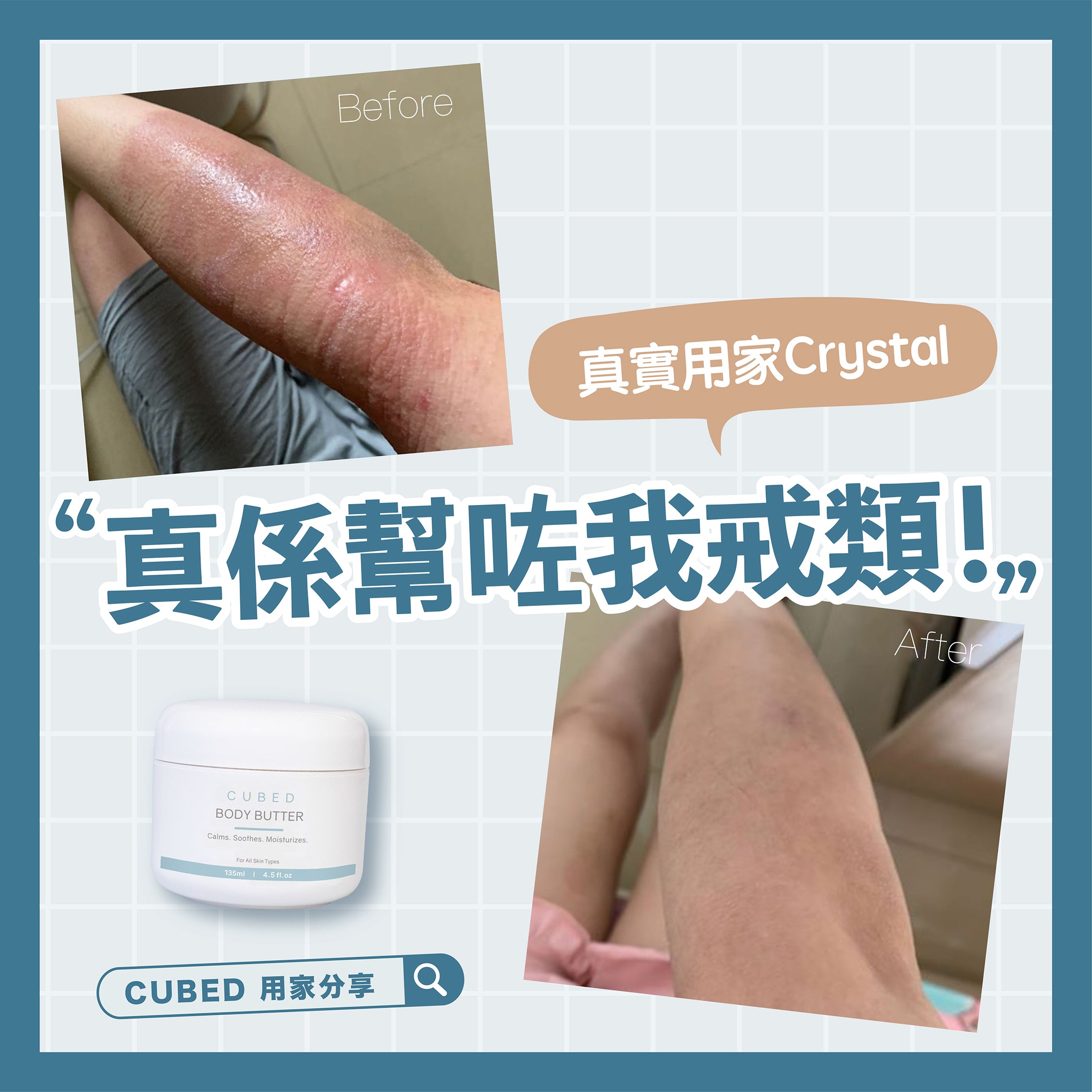 【類固醇反彈】真實用家分享:真係幫咗我戒類!