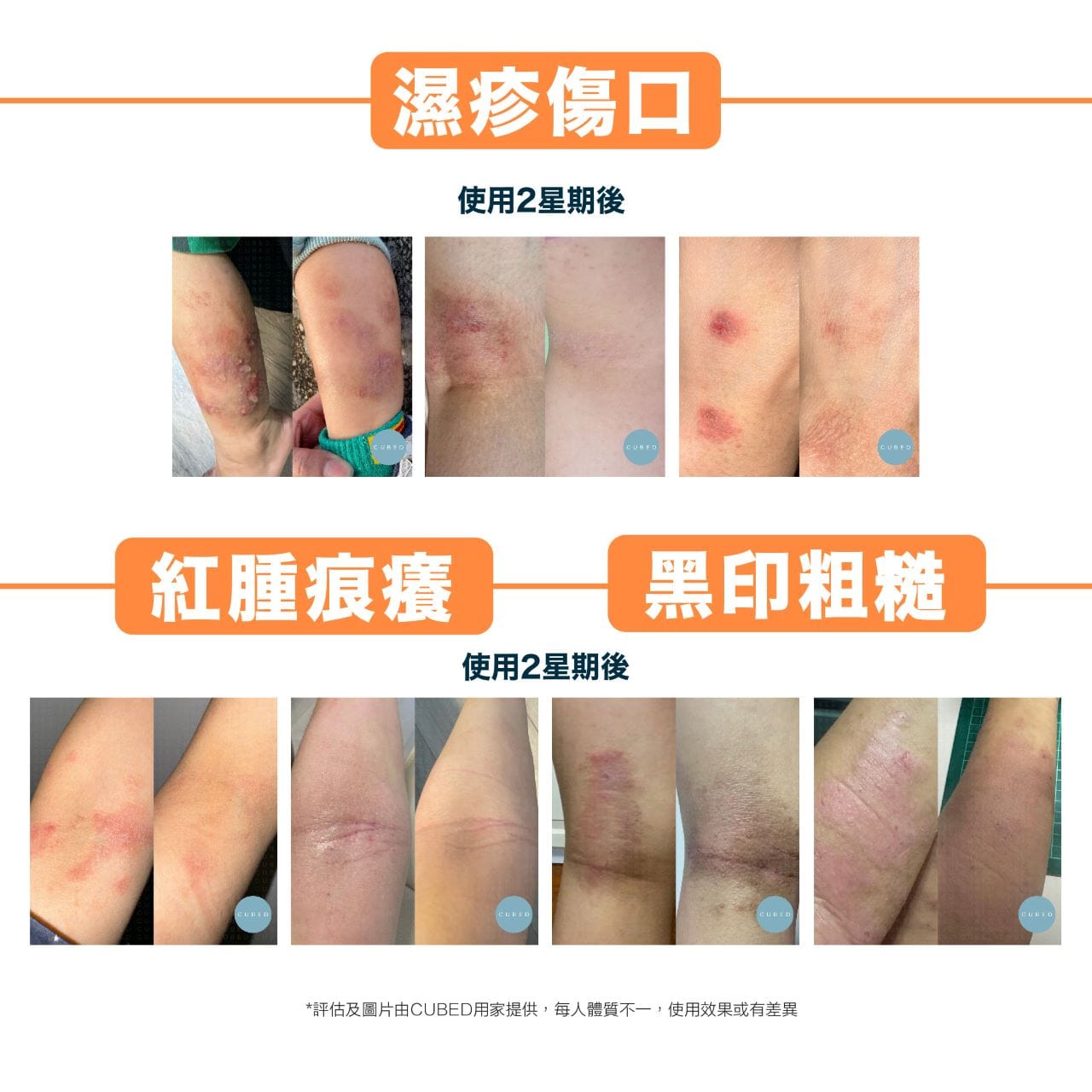 氧化鋅保濕紓緩繃帶 (半價優惠)