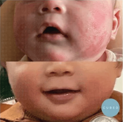 兒童濕疹紅痕乾癢 護理前後對比
