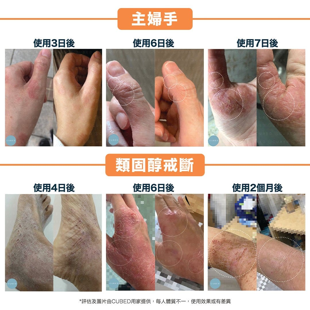 Cubed 皇牌護理組合 - 改善面部到身體濕疹發炎、紅腫痕癢及黑印 | 濕疹肌、類固醇戒斷推薦 | 過千用家回圖證實