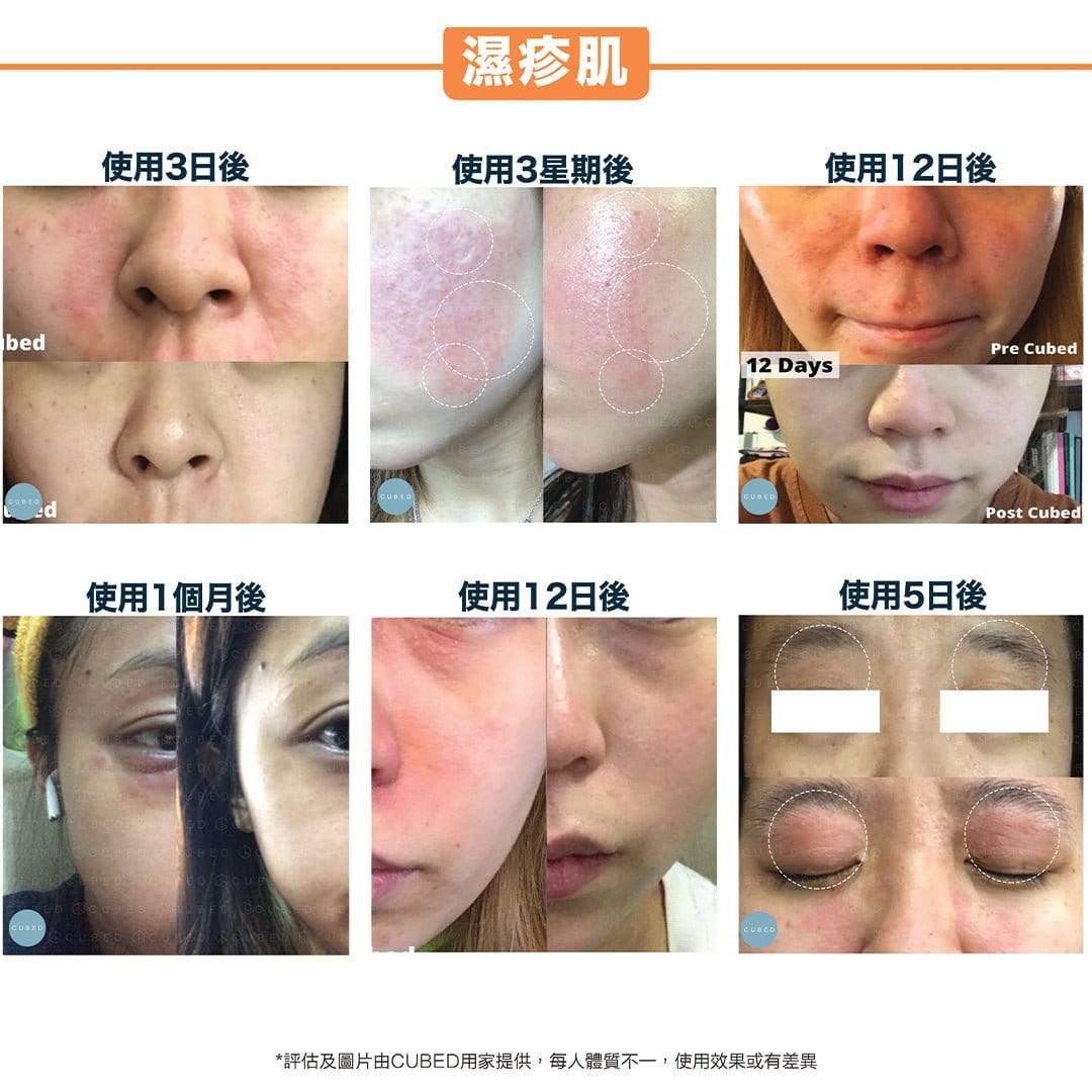 Cubed 皇牌護理組合 - 改善面部到身體濕疹發炎、紅腫痕癢及黑印 | 濕疹肌、類固醇戒斷推薦 | 過千用家回圖證實