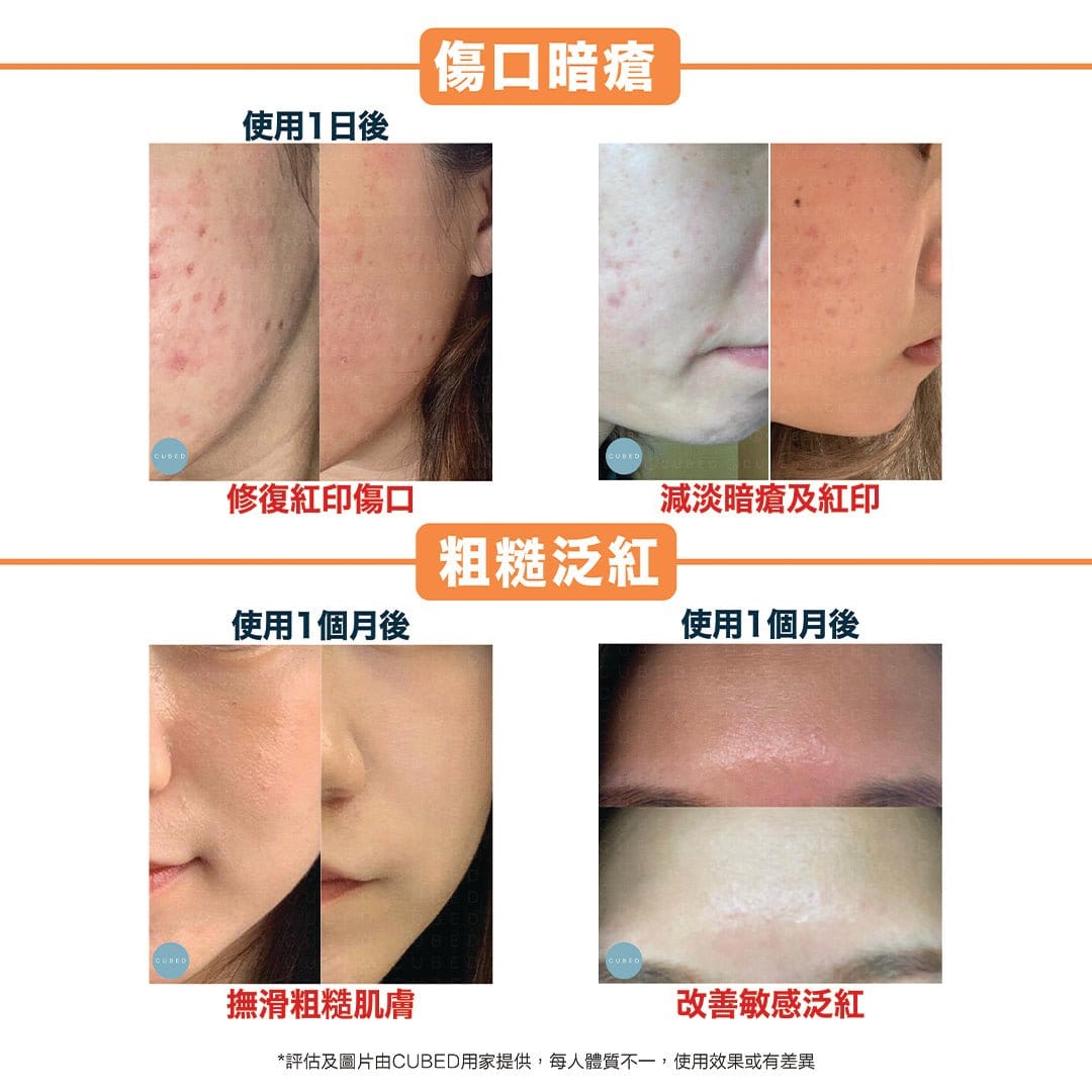 Cubed BFF精華 - 去暗瘡印暗粒,緊緻美白淡斑抗皺保濕 | 敏感肌、暗瘡肌乾肌推薦 | 過千用家回圖證實
