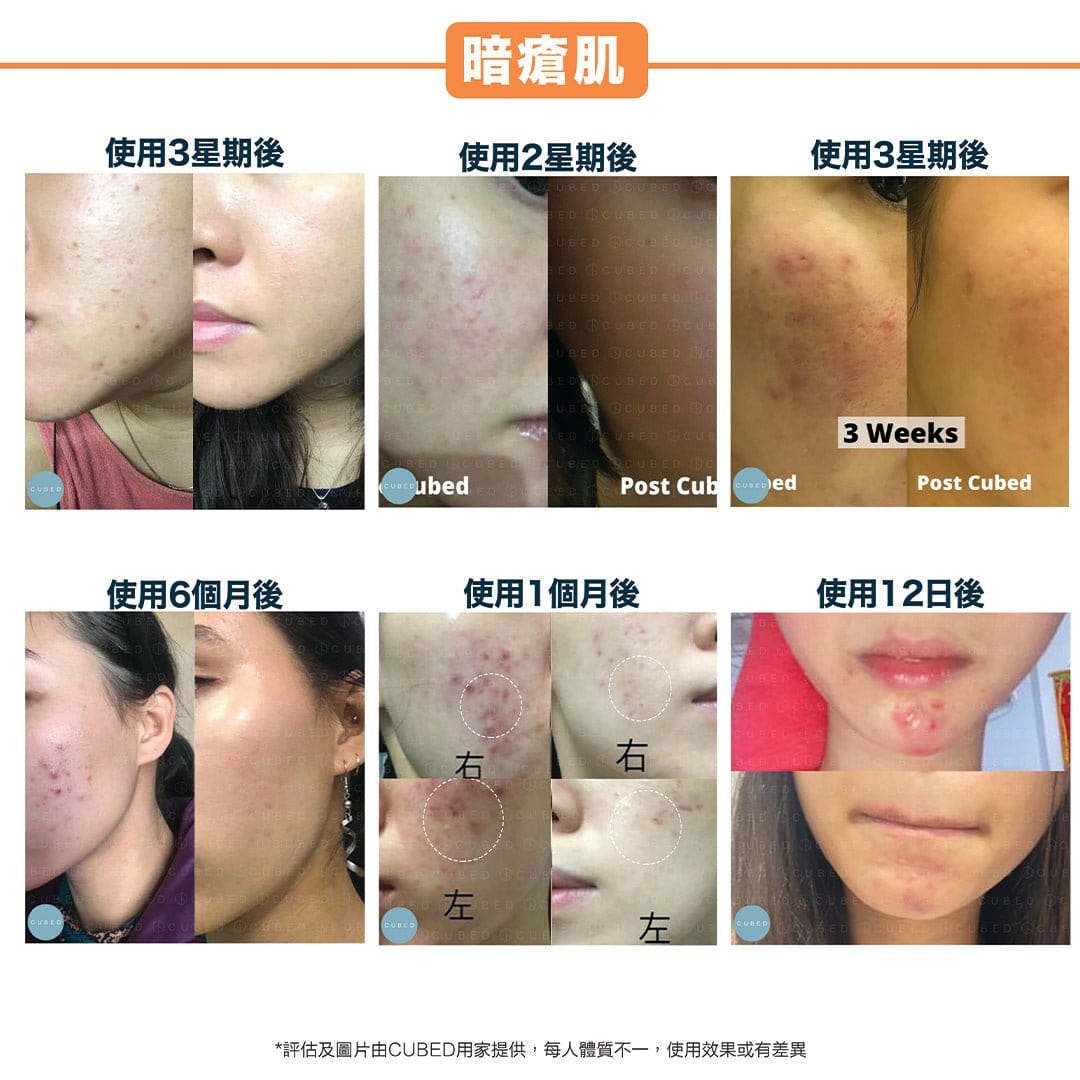 Cubed Daily Lotion 低敏修復乳液 - 鎮靜敏感泛紅,改善痘痘暗粒及暗瘡印 | 暗瘡肌、敏感肌推薦 | 過千用家回圖證實