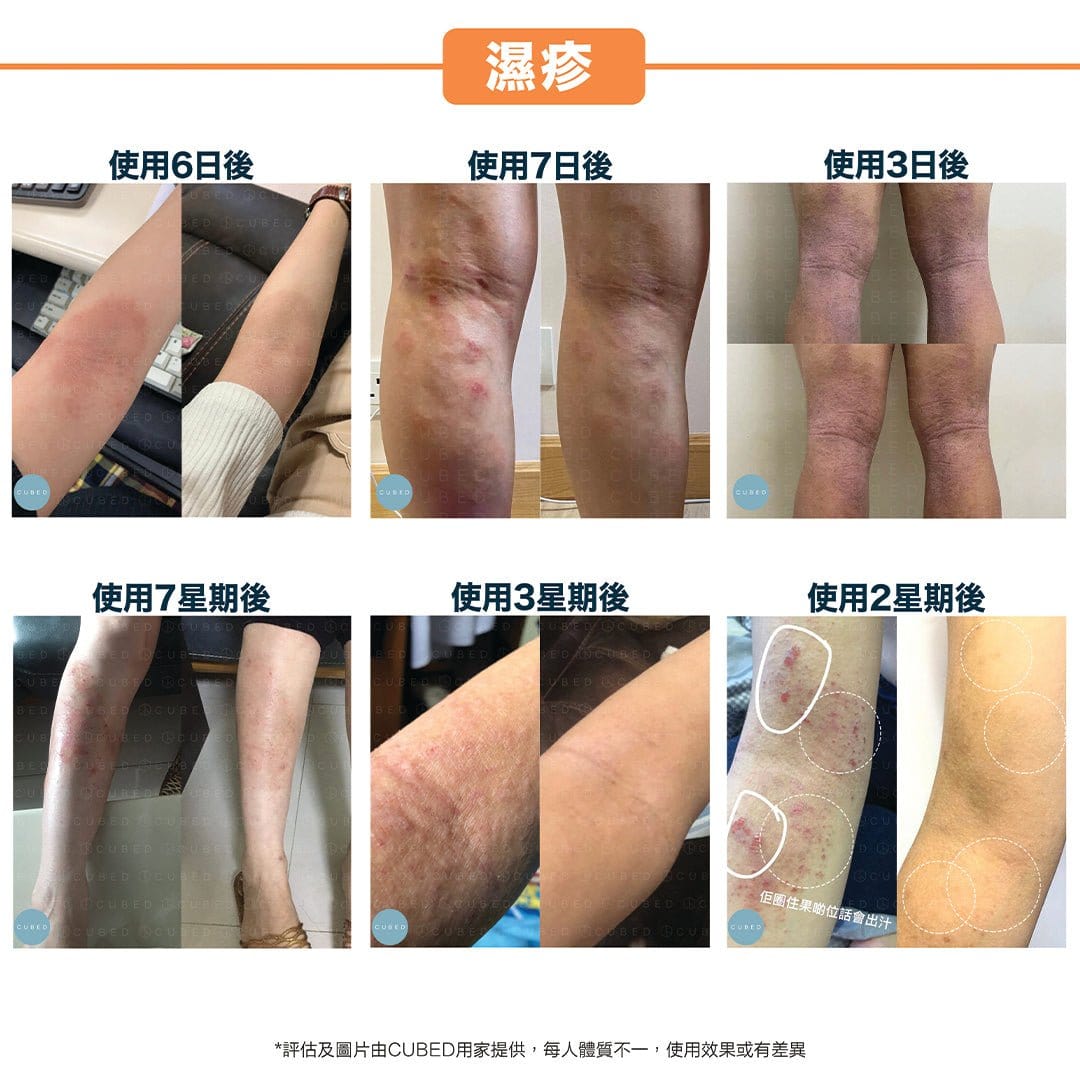 Cubed Body Oil 濕疹紓緩護理油 - 即時修護濕疹發炎痕癢及滲水傷口 | 濕疹肌、類固醇戒斷推薦 | 過千用家回圖證實