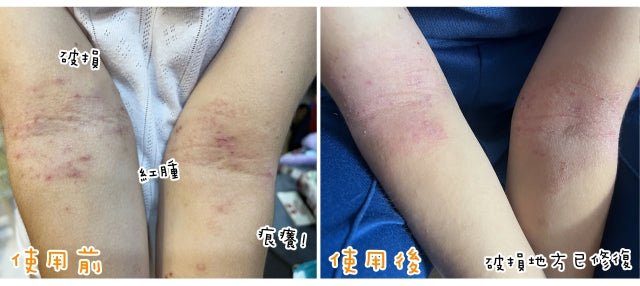 兒童濕疹｜8歲女孩濕疹爛腳自卑 靠CUBED護膚品好轉