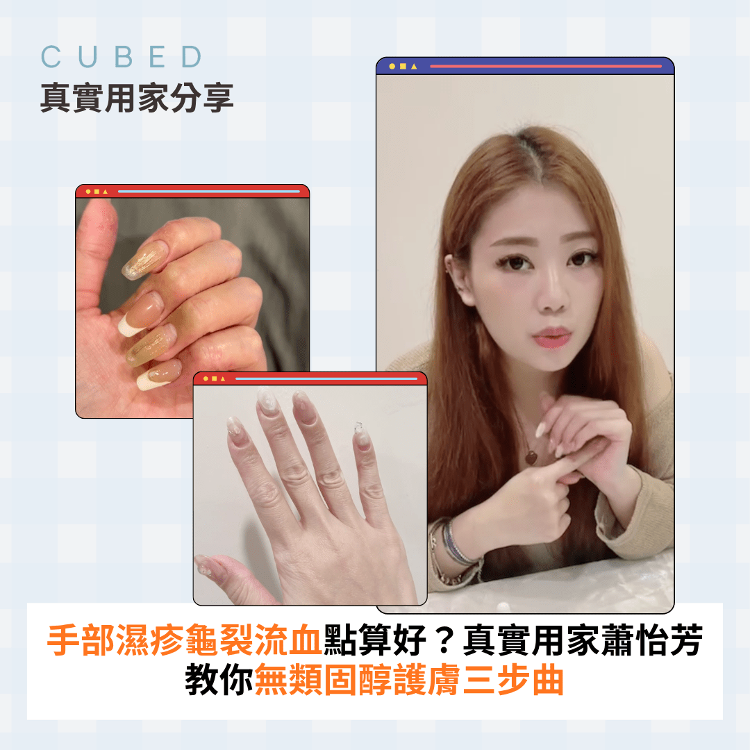 手部濕疹龜裂流血點算好？真實用家蕭怡芳教你無類固醇護膚三步曲