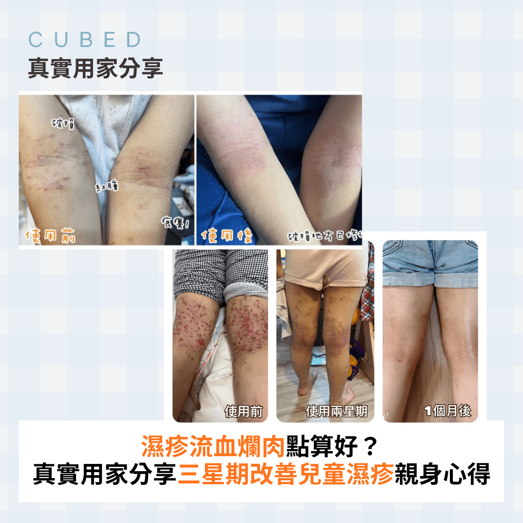 濕疹流血爛肉點算好？真實用家分享 CUBED Kids Set 三星期改善兒童濕疹親身心得