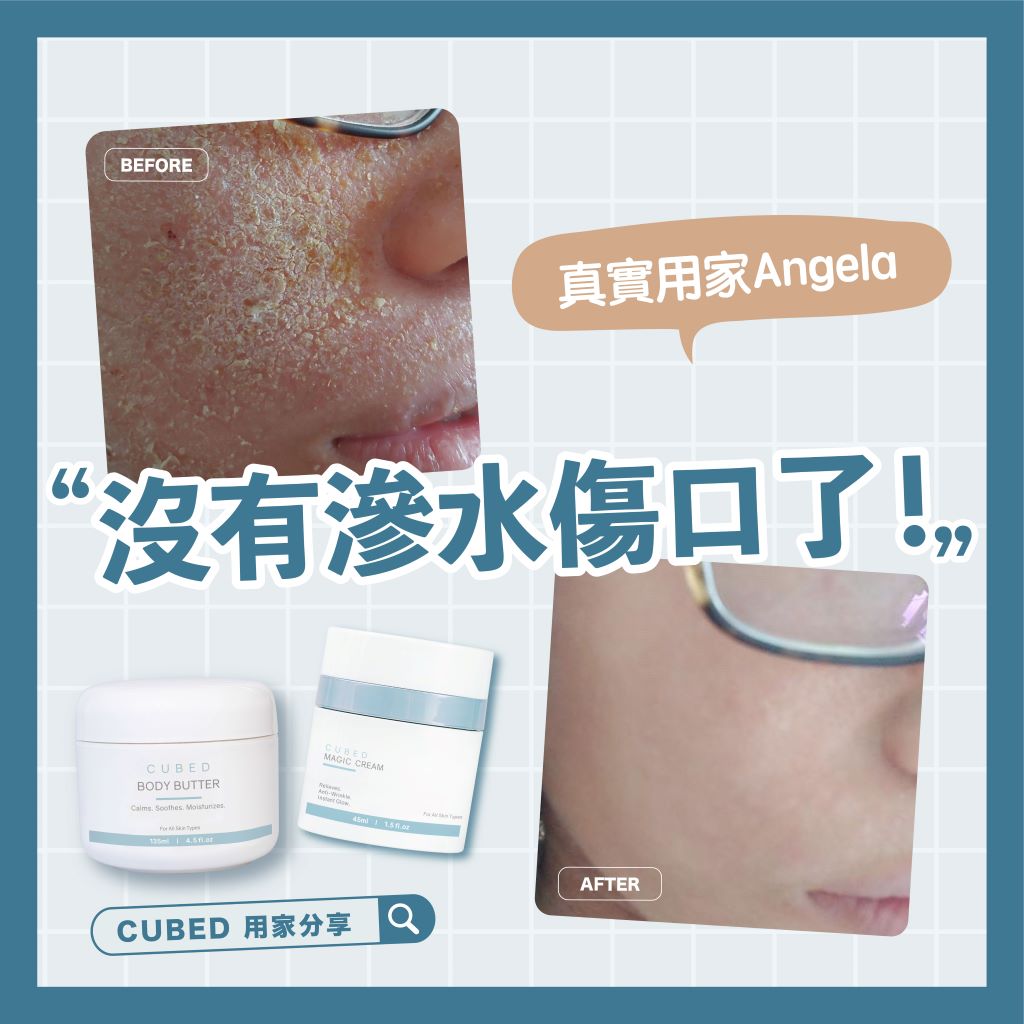 【類固醇反彈】Cubed 真實用家Angela對談｜戒類固醇最有用的方法