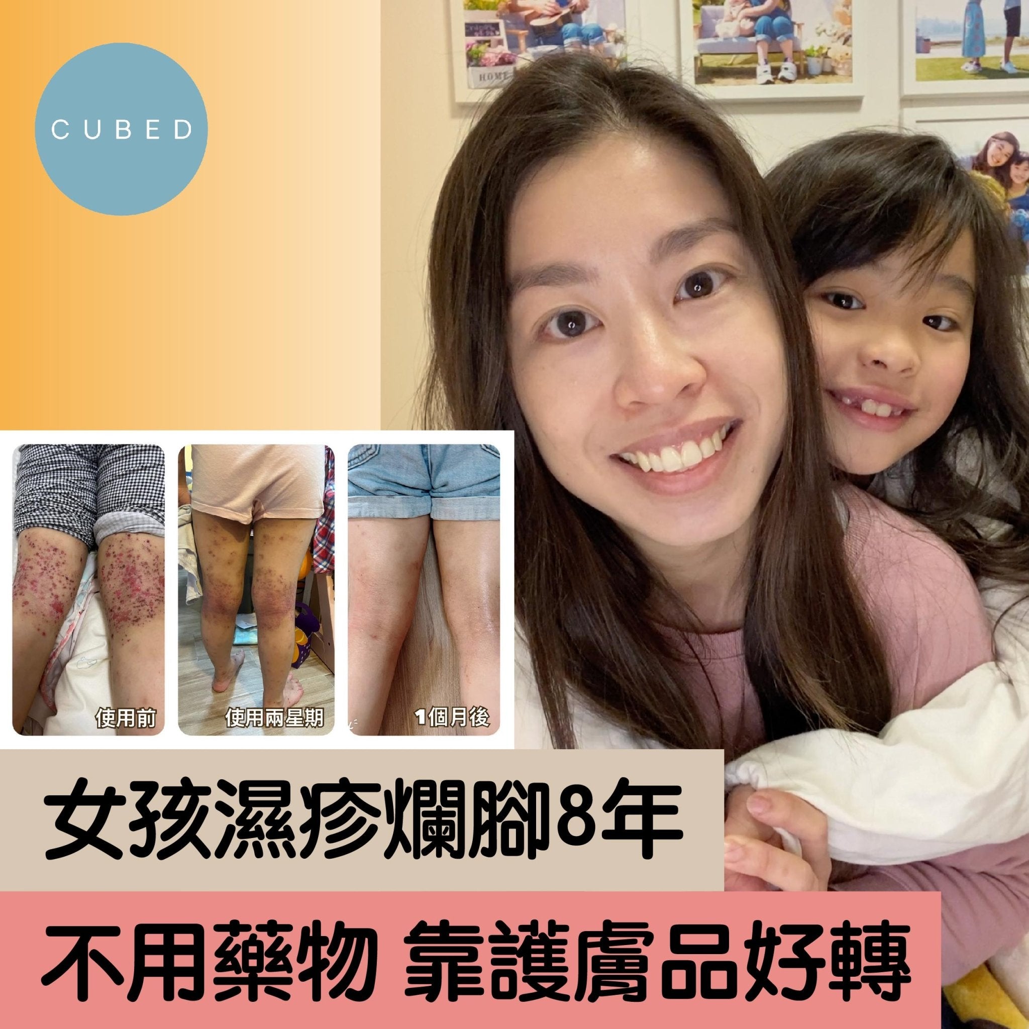 兒童濕疹｜8歲女孩濕疹爛腳自卑 靠CUBED護膚品好轉
