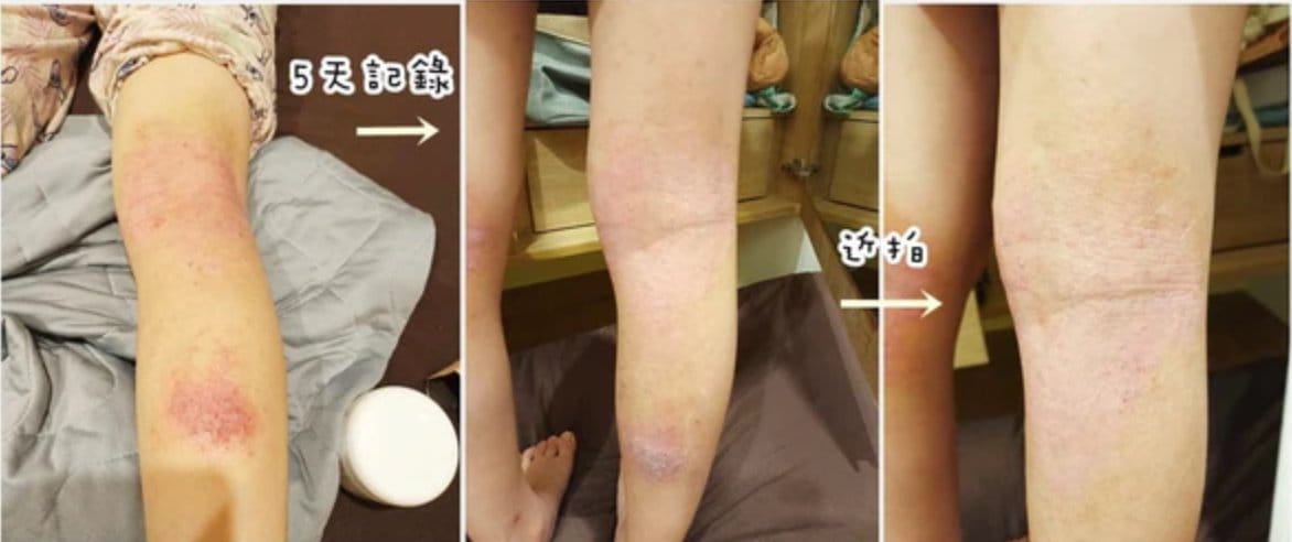 兒童濕疹紅腫乾癢 5天護理前後對比