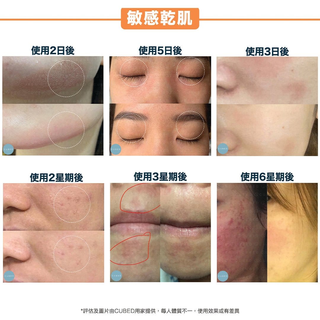 Cubed 皇牌護理組合 - 改善面部到身體濕疹發炎、紅腫痕癢及黑印 | 濕疹肌、類固醇戒斷推薦  | 過千用家回圖證實