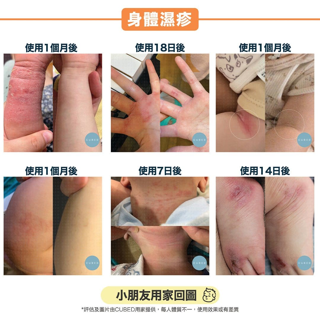 Cubed KIDS Body Oil 兒童濕疹紓緩護理油 - 即時修護濕疹發炎痕癢及滲水傷口，更適合幼嫩脆弱皮膚使用 | 兒童濕疹肌、類固醇戒斷推薦 | 用家回圖證實