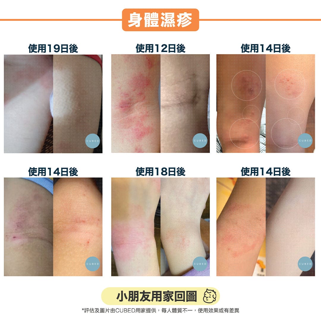 Cubed KIDS Body Butter 兒童低敏紓緩潤膚霜 - 即時修護濕疹痕癢及紅腫發炎，更適合幼嫩脆弱皮膚使用 | 兒童濕疹肌、類固醇戒斷推薦 | 用家回圖證實