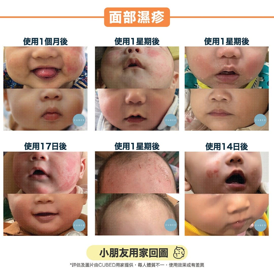 Cubed 兒童雙層修護組合 - 迅速紓緩濕疹發炎黑印紅腫紅疹及滲水傷口，更適合幼嫩脆弱皮膚使用 | 兒童濕疹肌、類固醇戒斷推薦 | 用家回圖證實