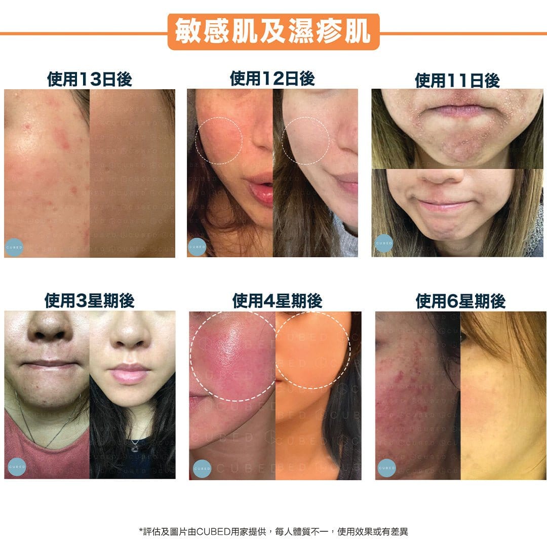 Cubed 柔膚光澤組合 - 紓緩敏感泛紅及減淡色素沉澱，美白提升光澤 | 敏感肌、暗瘡肌推薦  | 過千用家回圖證實