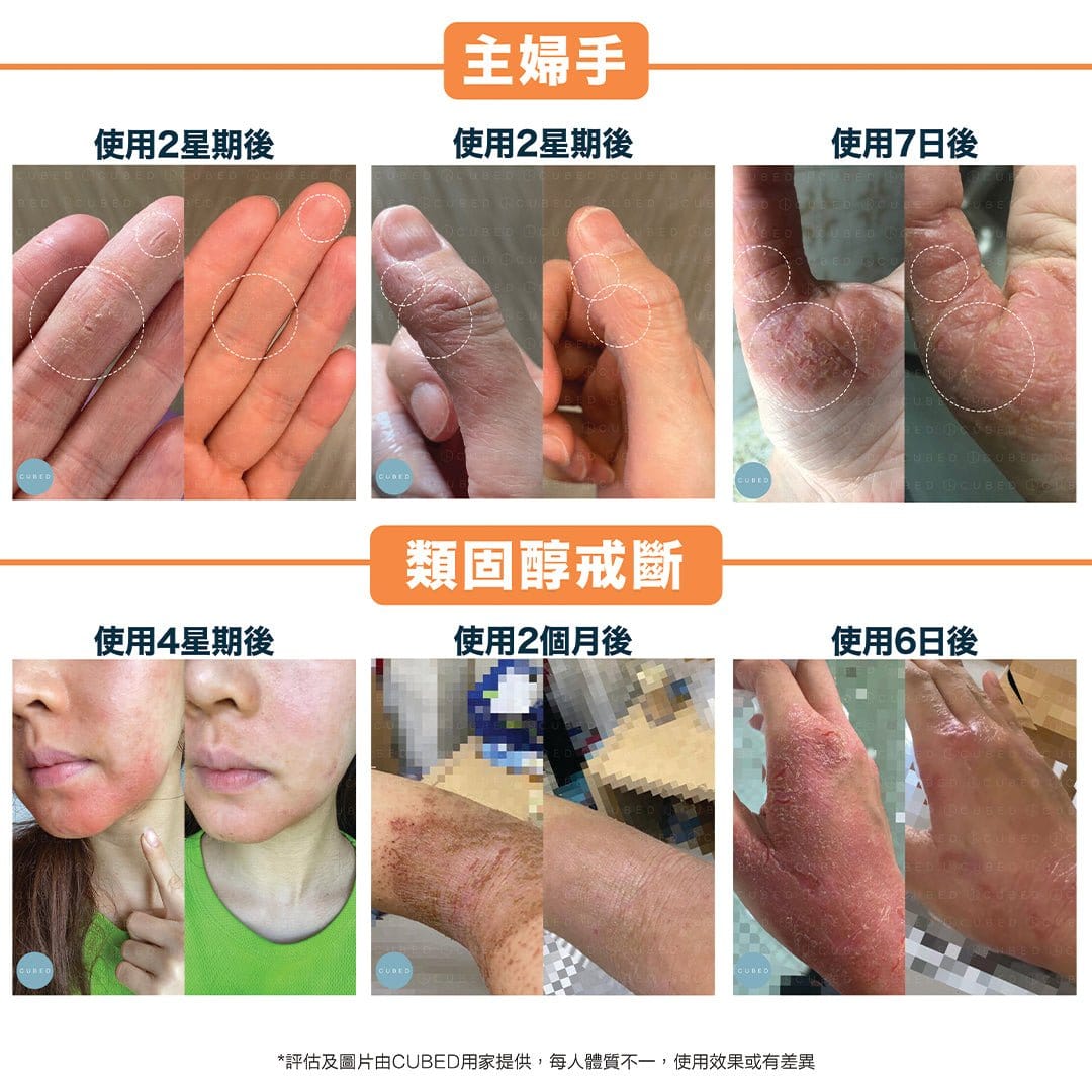 Cubed Body Oil 濕疹紓緩護理油 - 即時修護濕疹發炎痕癢及滲水傷口 | 濕疹肌、類固醇戒斷推薦  | 過千用家回圖證實